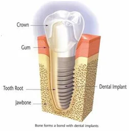 dental-implants3-1